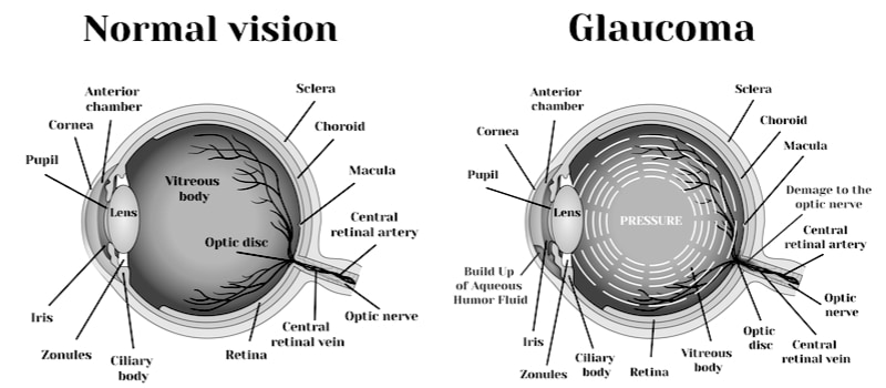 glaucoma,glaucoma sydney