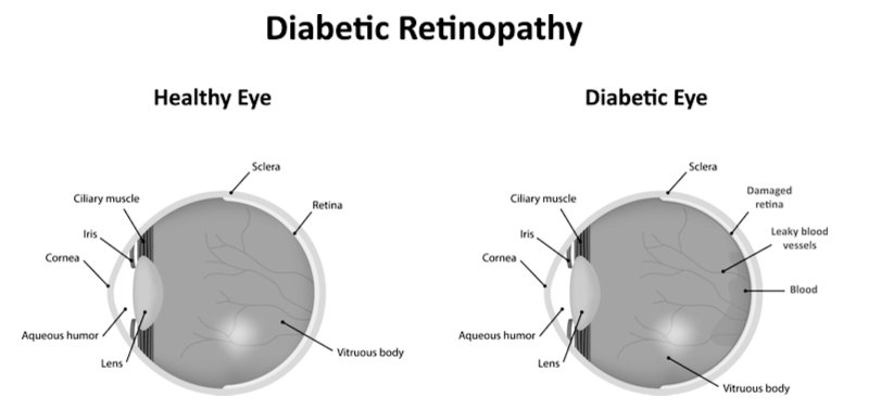 diabetic eye disease diagram