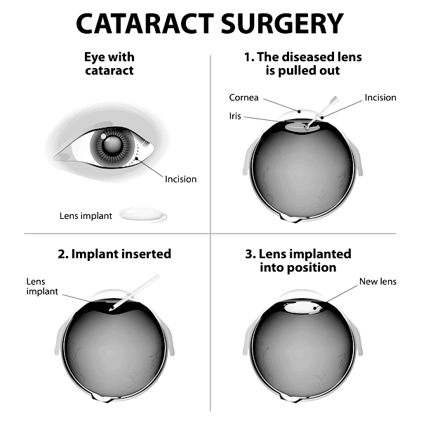 Cataract Surgery Diagram