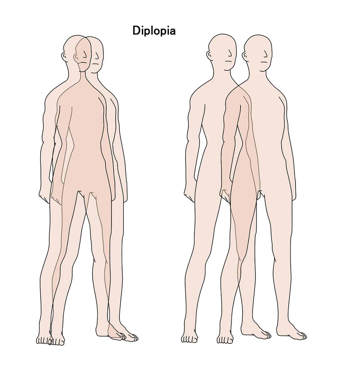 Double Vision Diplopia