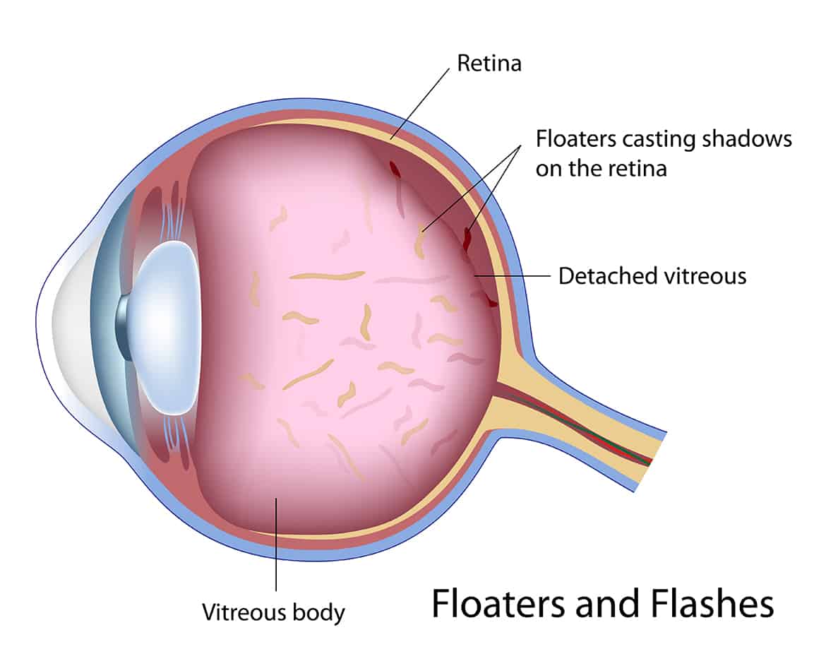 How To Reduce Eye Floaters The Binetter Eye Centre